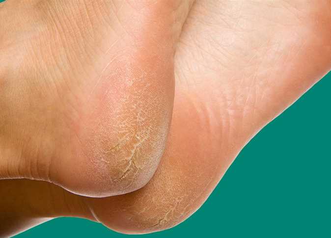 علاج تشققات القدم