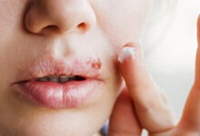 تعليق الدراسة بفصل في مدرسة دولية بسقارة عقب ظهور إصابات بفيروس شائع