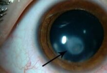 الفرق بين عمليات الليزك والفيمتو ليزك والالترا ليزك