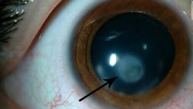 الفرق بين عمليات الليزك والفيمتو ليزك والالترا ليزك