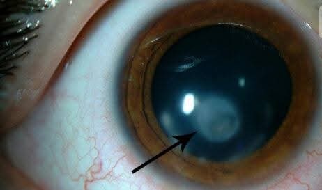 الفرق بين عمليات الليزك والفيمتو ليزك والالترا ليزك