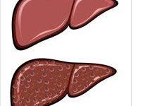 اعراض الكبد الدهنى