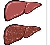 اعراض الكبد الدهنى