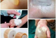 تحذير طبي من حروق الشاي المغلي