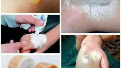 تحذير طبي من حروق الشاي المغلي